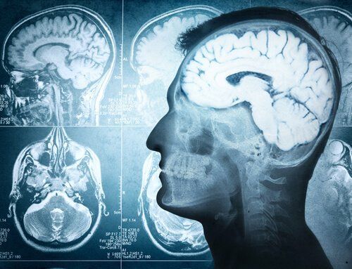 inflamacion de vasos cerebrales