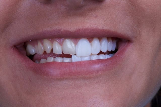 The Pros and Cons of Veneers