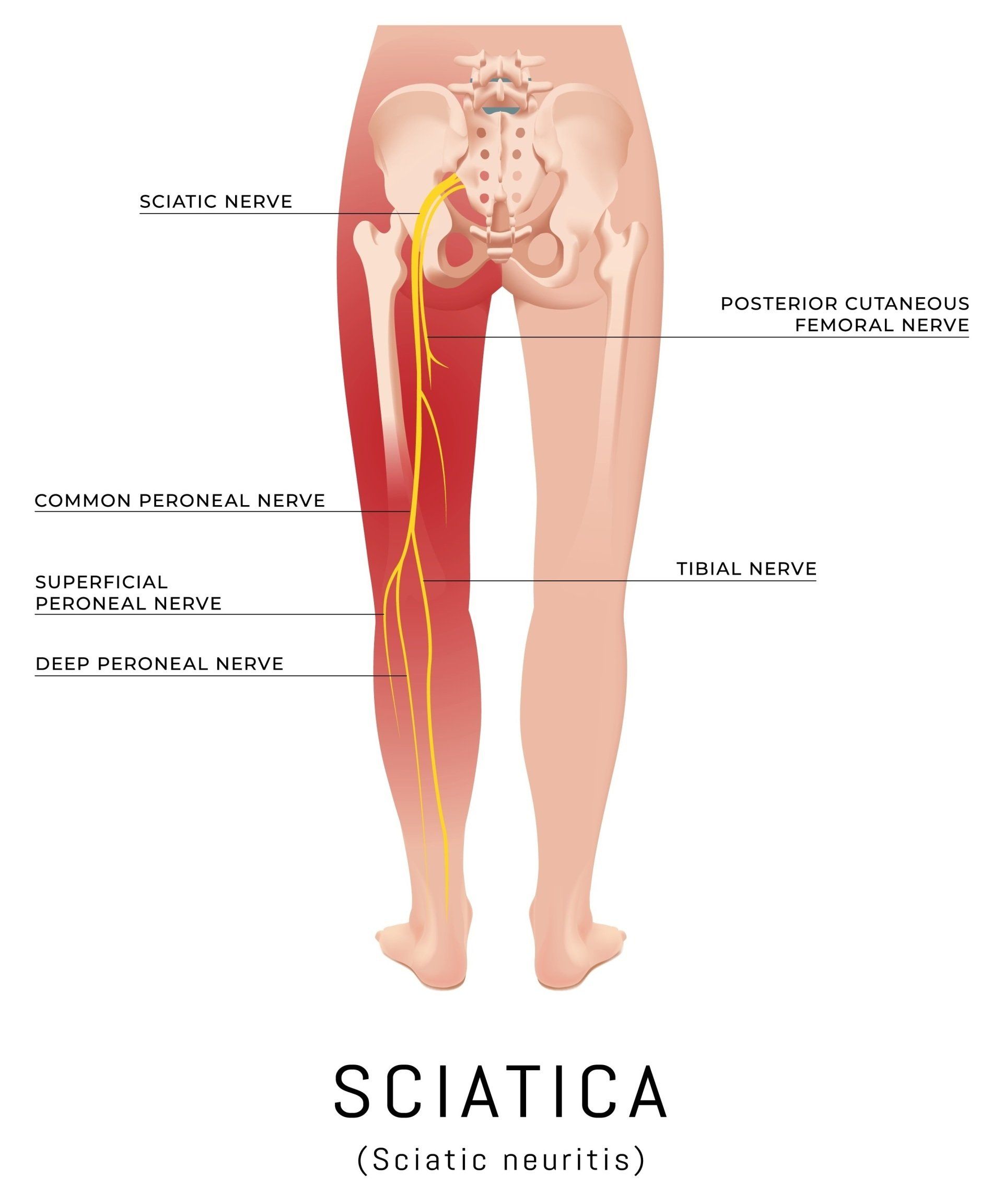 Definition Of Sciatic Nerve In Spanish