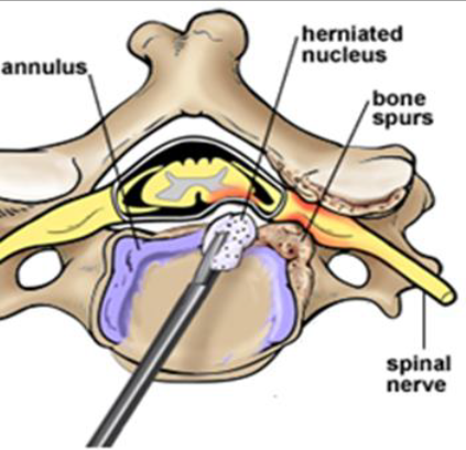 Anterior Cervical Discectomy And Fusion Acdf Orthospine Advance Health Inc Merced Ca