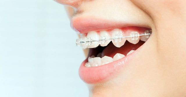 teeth straightening lincoln