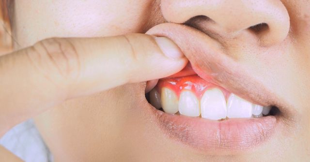 How to fight gum diseases
