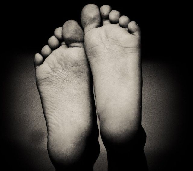 recurring corn on bottom of foot