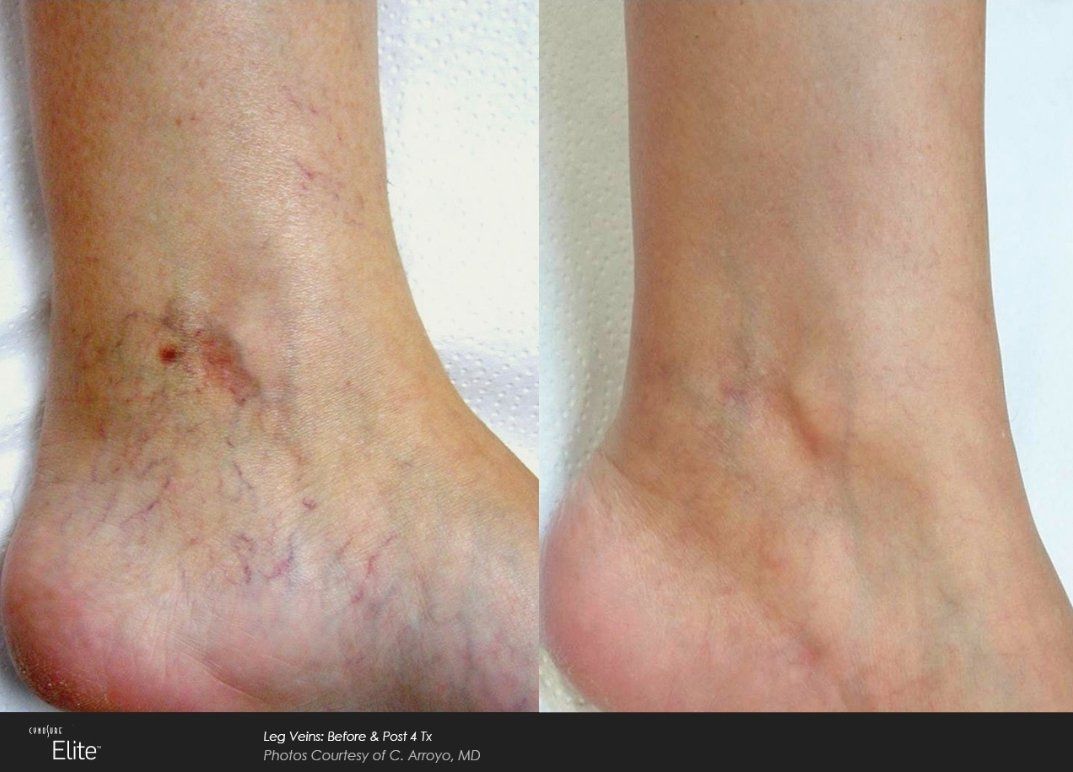 Thread vein removal Revekka Treatments