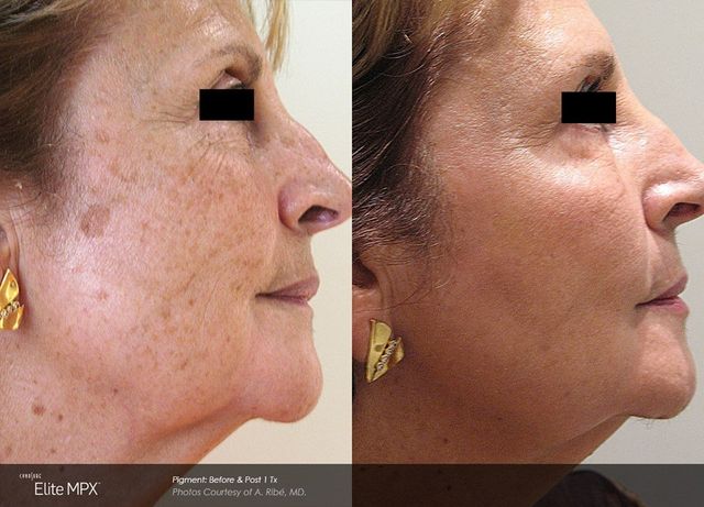 revlite laser before and after