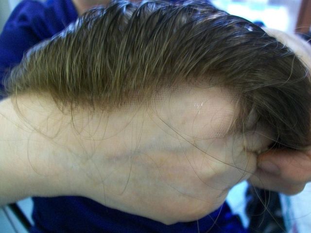 protesi capelli torino