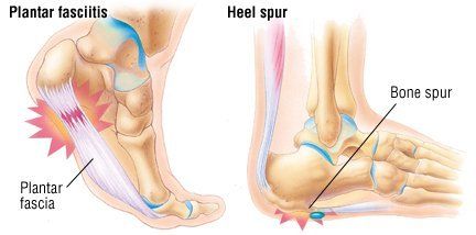 bone enlargement in heel