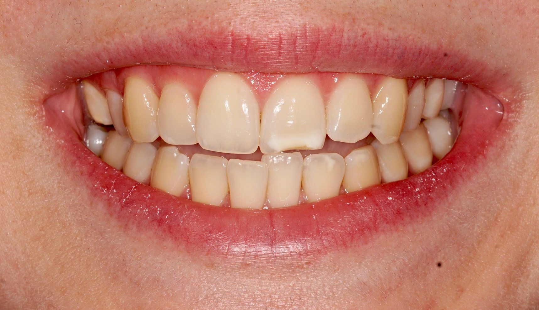 Invisalign