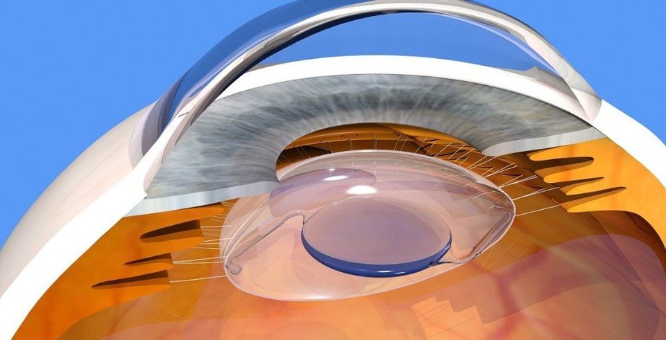 Intraolcular Lens Implants Gregory Cox, M.D. Eye