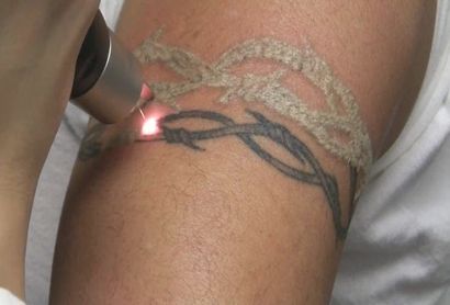 tattoo Removal