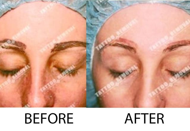 28+ Eyebrow Tattoo Removal Healing Process Pics