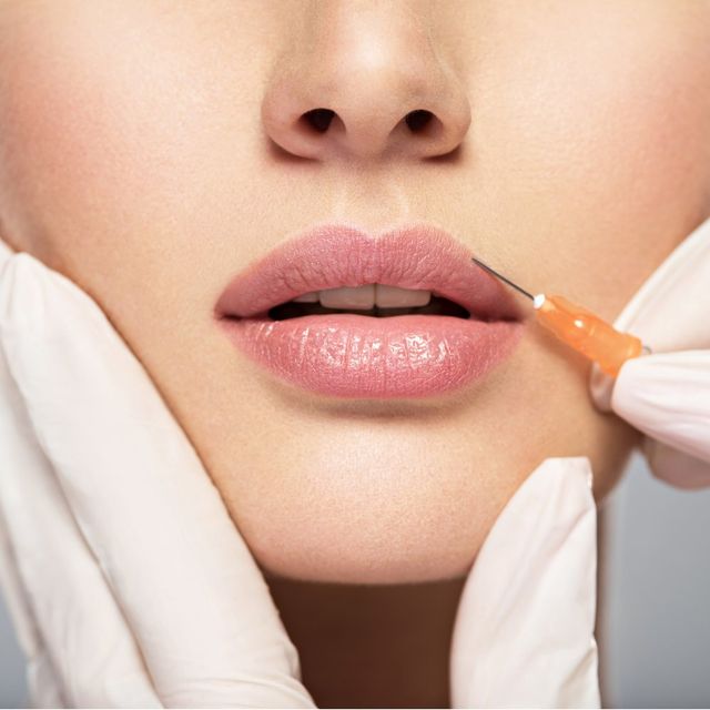 Lippenbehandlung Lippen Aufspritzen Hyaluron Biolifting Heilpraktiker Ravensburg Lippenotpimierung
