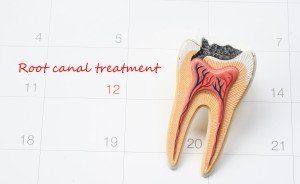 root canal treatment