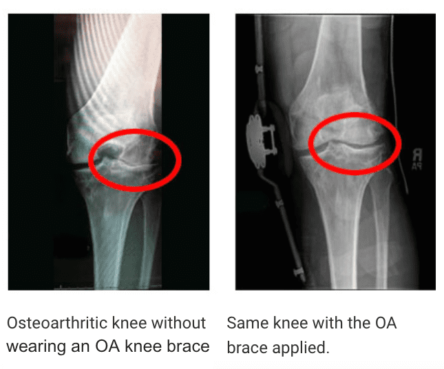 Unloading Knee Braces How do they work?