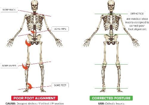 Posture Skeleton Diagram — Podiatry Fees in Kingscliff, NSW
