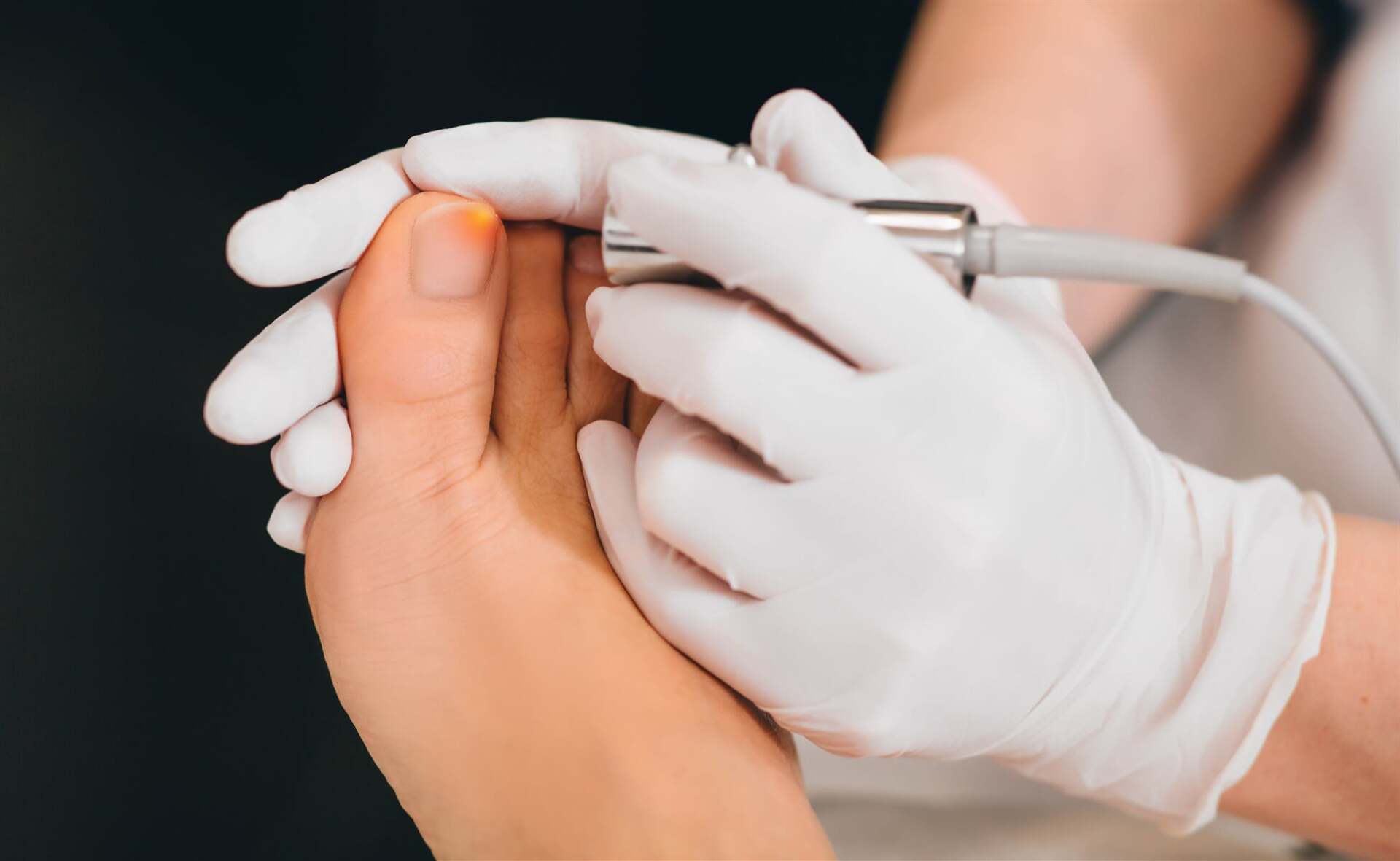 Update more than 136 do podiatrists treat nail fungus