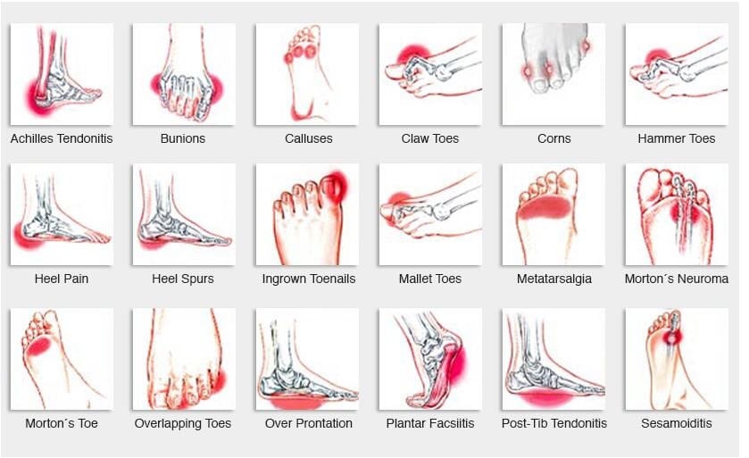 Foot Conditions — Laser Therapy in Kingscliff, NSW