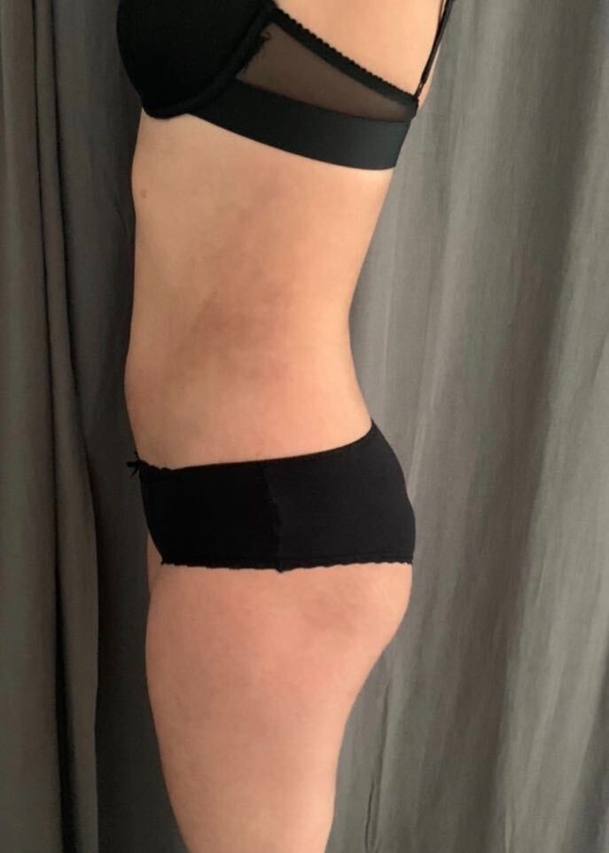 Tarifs Liposuccion Haute Definition Lipo Hd