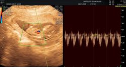 Estudio doppler