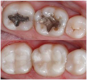 amalgam vs composite
