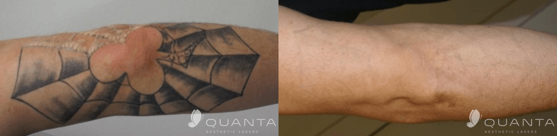 Shipers Laser Tattoo Removal Center Dallas