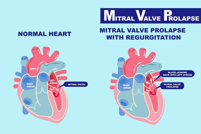 Resultado de imagen de Mitral Valve Prolapse