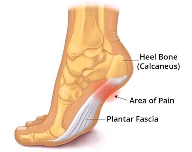 plantar fasciitis treatment shock wave therapy