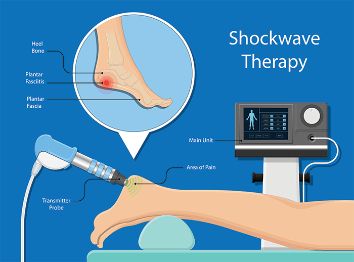 Shockwave Therapy For Plantar Fasciitis 