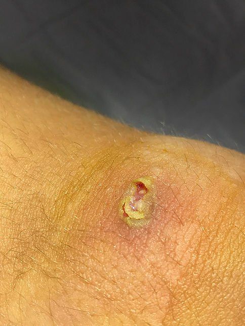 School Sores | Impetigo | Brisbane Doctors