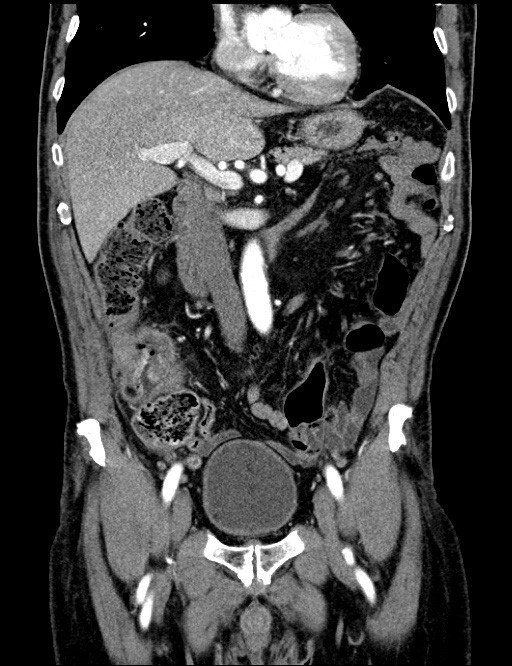 Neoplasia Al Colon Roma Prof Sammartino Paolo