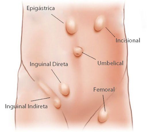 Tipos de hernia abdominal
