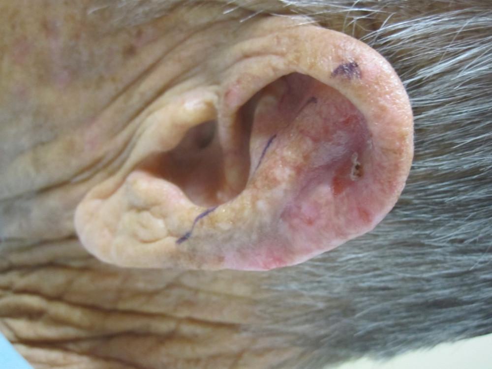 Mohs Case Before And After Infiltrative Basal Cell Carcinoma 