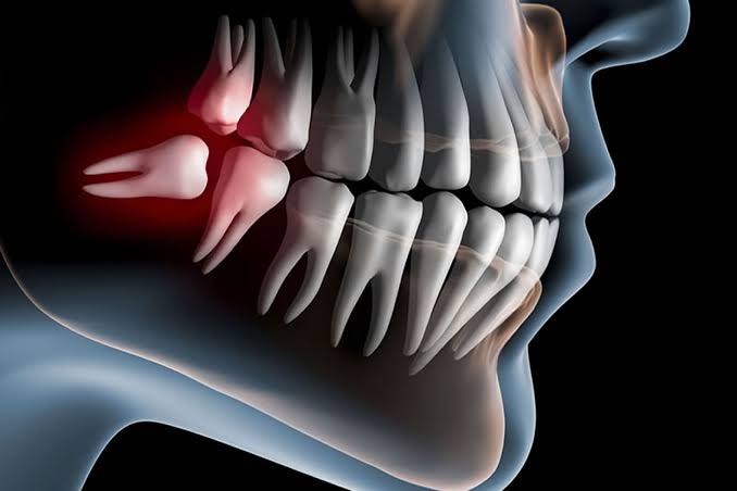 Extracao Dental Siso Em Fortaleza Saiba Tudo Sobre