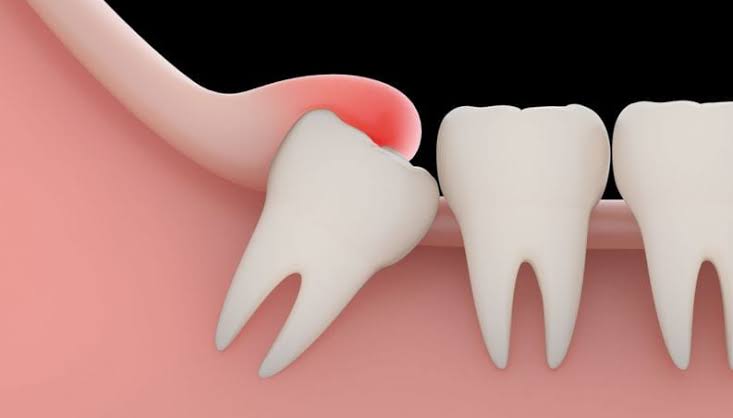 Extracao Dental Siso Em Fortaleza Saiba Tudo Sobre