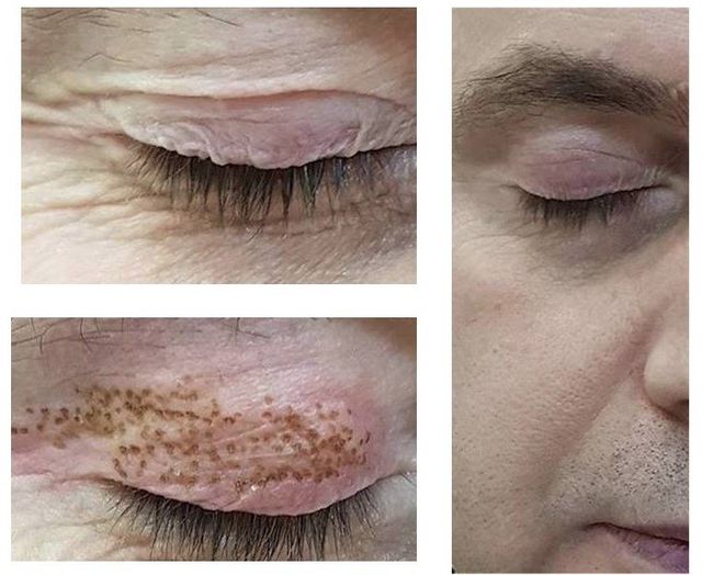 Non Surgical Skin Tightening Darwin Anita S Health And Beauty Parap