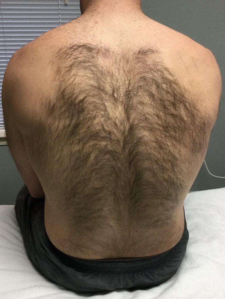 Laser Hair Removal | Memphis Laser Clinic and Medspa ...