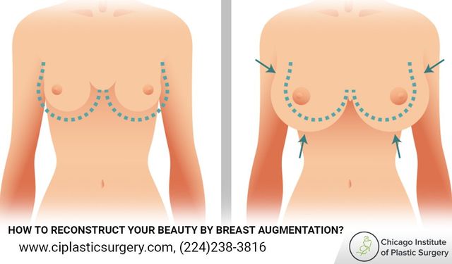 Breast Augmentation Surgery Austin Tx