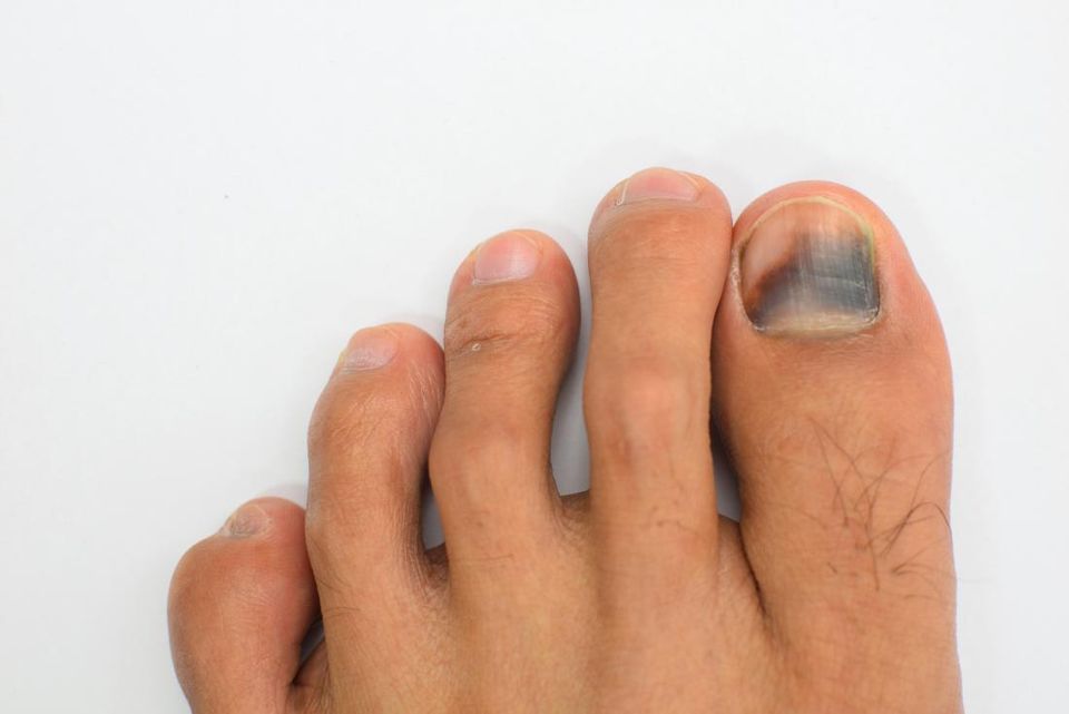 i-have-a-black-toenail-should-i-be-worried