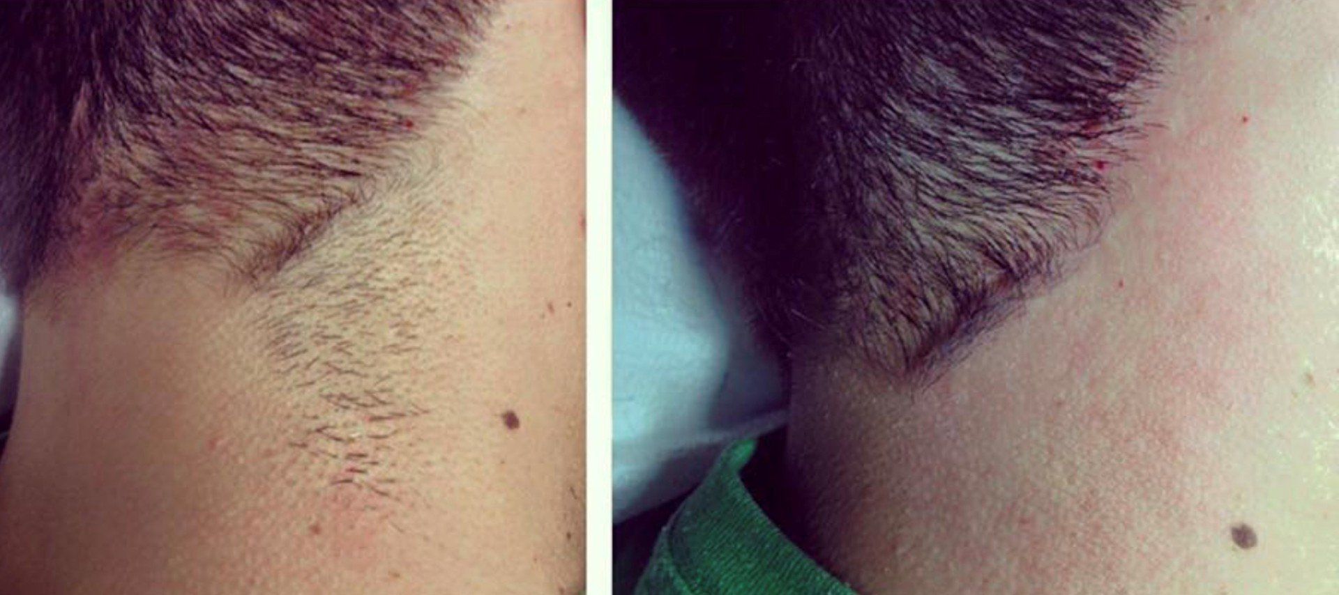 Electrolysis & Med Spa before & after Dallas, TX Hair Today Gone