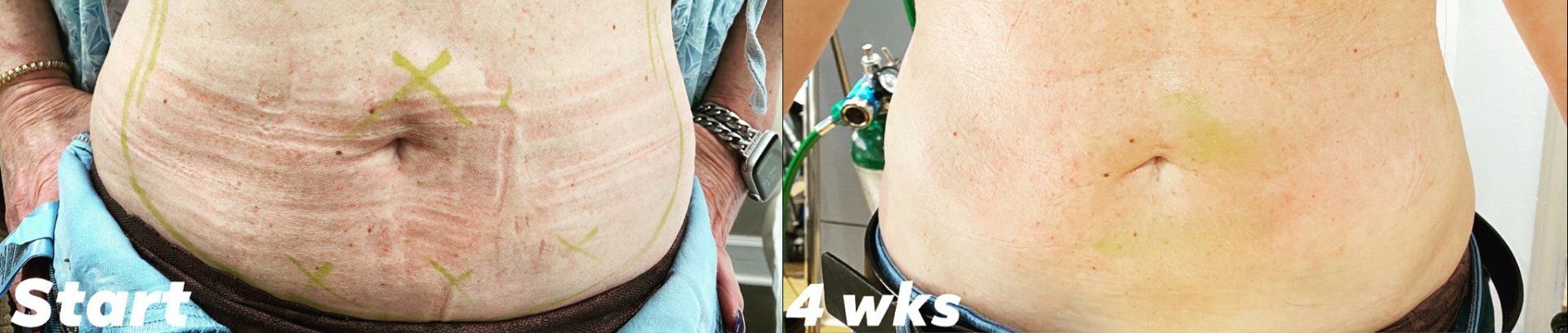Morpheus8 - Minimally Invasive Body & Skin Contouring