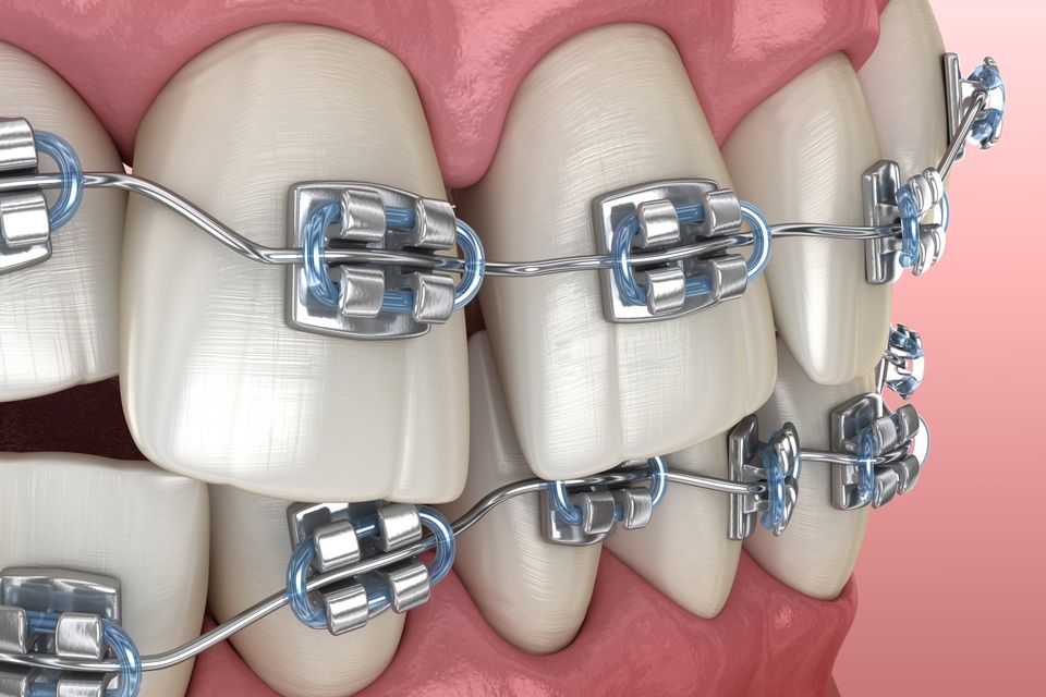 Correct Your Bite with Functional Orthodontics