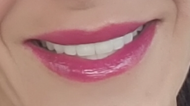 Hialeah Gardens Florida Cracked Tooth Dentist Chipped Tooth Repair Services